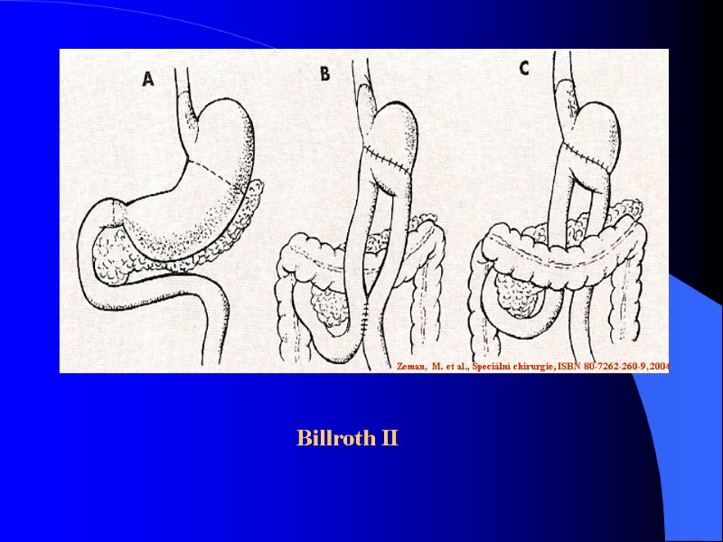 Billroth II Zeman, M. et al., Speciální chirurgie, ISBN 80-7262-260-9, 2004